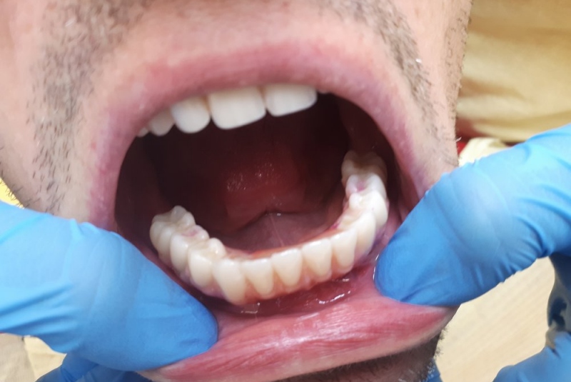 Totálna implantologická náhrada zubov v dolnej čeľusti