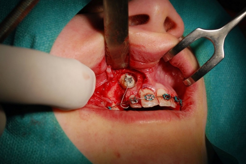 Patefakcia (čeľustno-ortotodontické sťahovanie, zle postave- ných zubov do oblúka)