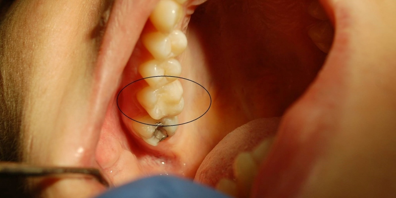 Fotokompozitné výplne Fotokompozitné výplne