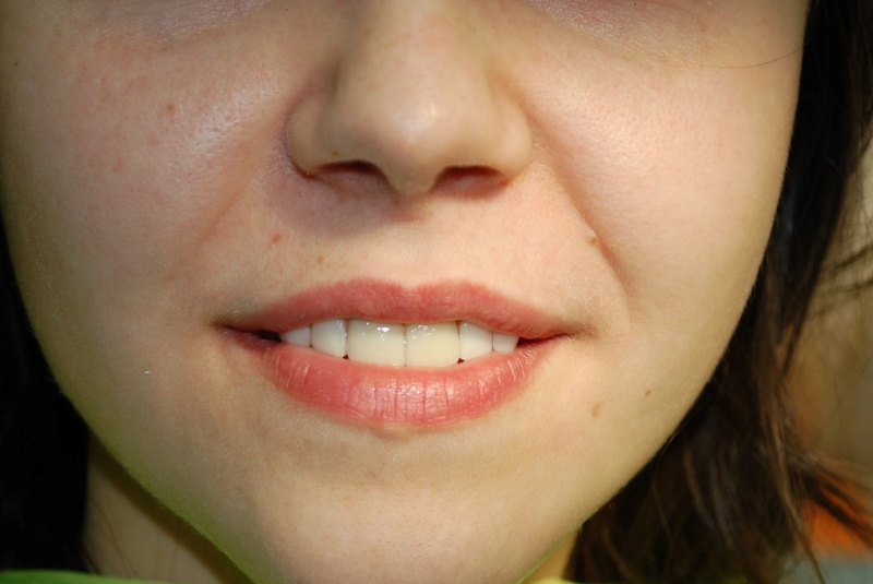 Fazety a nepriame výplne Fazety a nepriame výplne