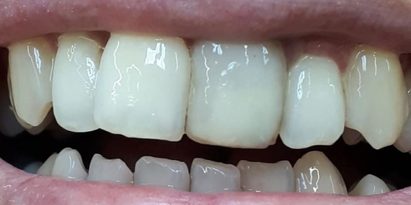 Kovokeramická korunka Kovokeramická korunka