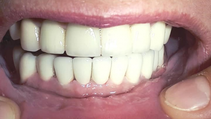 Kovokeramická konštrukcia Kovokeramická konštrukcia