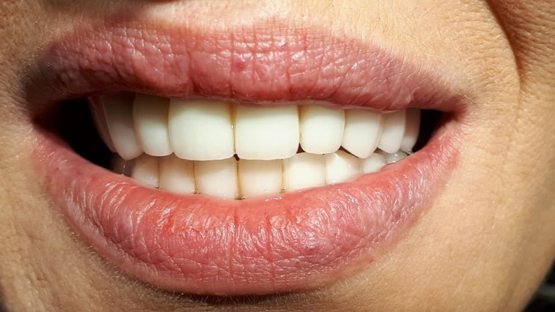 Zirkónová konštrukcia Zirkónová konštrukcia