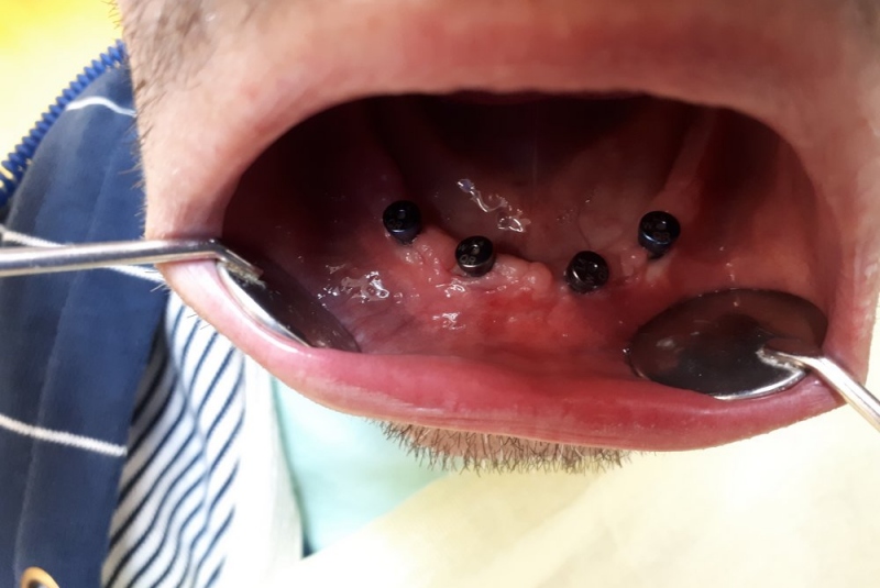 Totálna implantologická náhrada zubov v dolnej čeľusti Totálna implantologická náhrada zubov v dolnej čeľusti