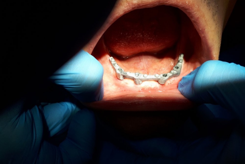 Totálna implantologická náhrada zubov v dolnej čeľusti Totálna implantologická náhrada zubov v dolnej čeľusti