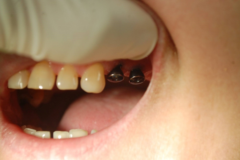 Sólo korunky, nahradené implantátmi Sólo korunky, nahradené implantátmi