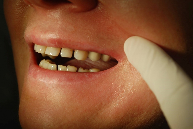 Sólo korunky, nahradené implantátmi Sólo korunky, nahradené implantátmi