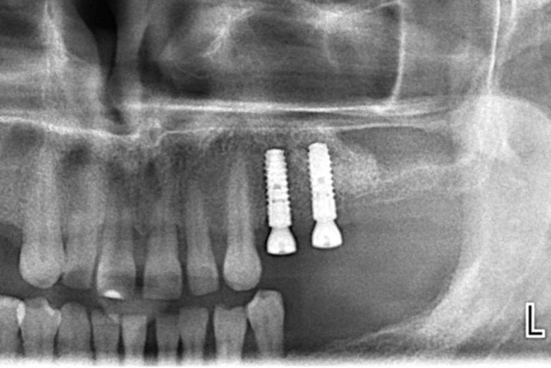 Sólo korunky, nahradené implantátmi Sólo korunky, nahradené implantátmi