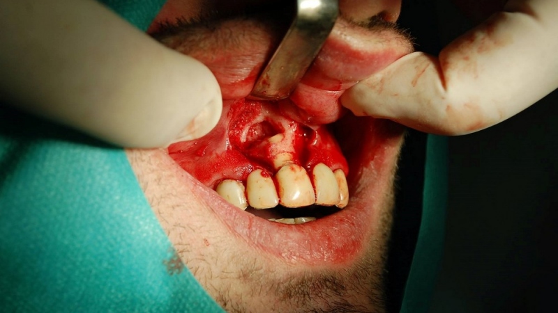 Resekcia (odstránenie zápalového ložiska zubného pôvodu)