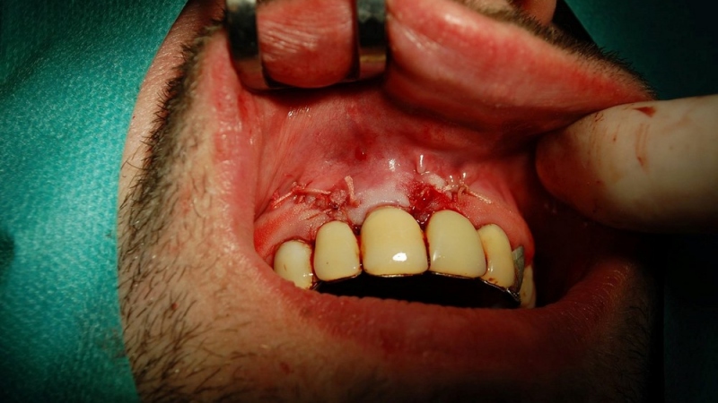 Resekcia (odstránenie zápalového ložiska zubného pôvodu) Resekcia (odstránenie zápalového ložiska zubného pôvodu)