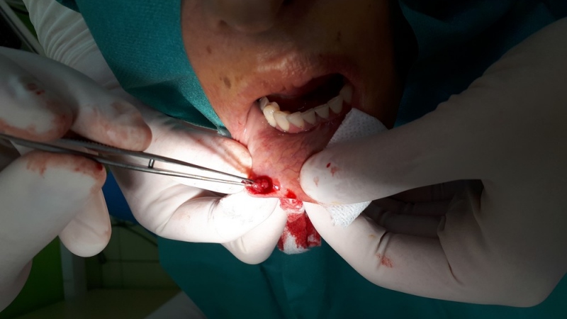 Excízie (odsránenie patologických ložísk, vrátane histologického vyšetrenia) Excízie (odsránenie patologických ložísk, vrátane histologického vyšetrenia)