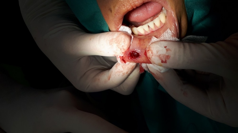 Excízie (odsránenie patologických ložísk, vrátane histologického vyšetrenia) Excízie (odsránenie patologických ložísk, vrátane histologického vyšetrenia)