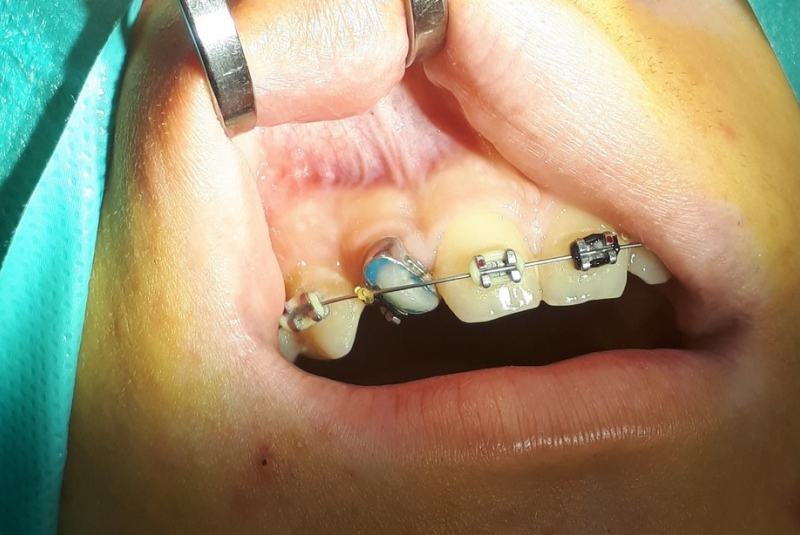 Patefakcia (čeľustno-ortotodontické sťahovanie, zle postave- ných zubov do oblúka) Patefakcia (čeľustno-ortotodontické sťahovanie, zle postave- ných zubov do oblúka)