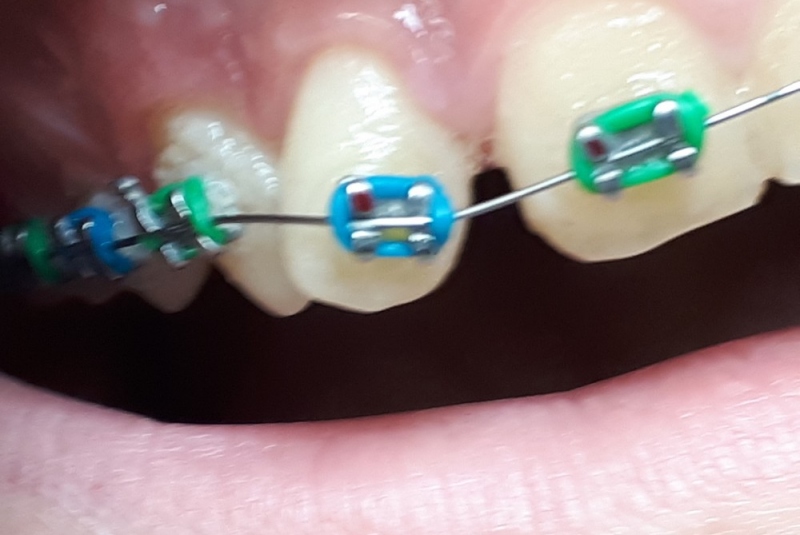 Patefakcia (čeľustno-ortotodontické sťahovanie, zle postave- ných zubov do oblúka) Patefakcia (čeľustno-ortotodontické sťahovanie, zle postave- ných zubov do oblúka)