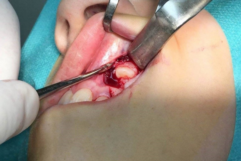 Chirurgické extrakcie Chirurgické extrakcie