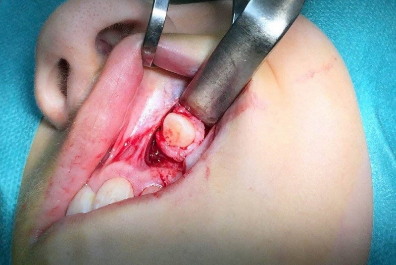 Chirurgické extrakcie Chirurgické extrakcie