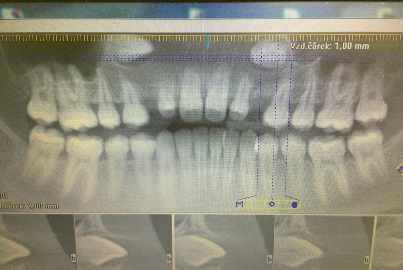 Chirurgické extrakcie - rentgen Chirurgické extrakcie - rentgen