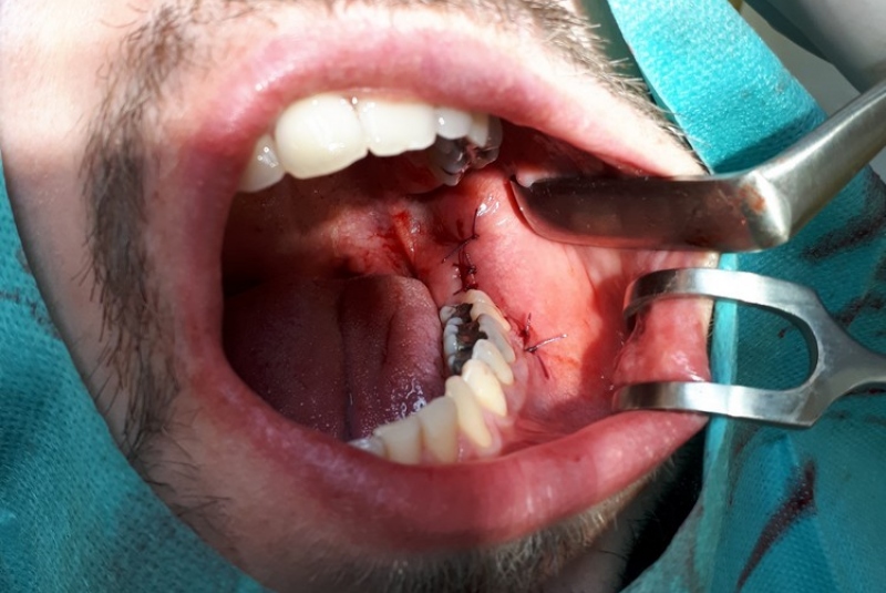 Chirurgické extrakcie Chirurgické extrakcie