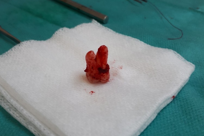 Chirurgické extrakcie - zub