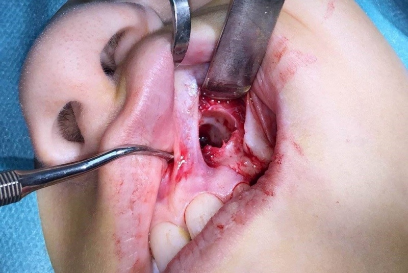 Chirurgické extrakcie