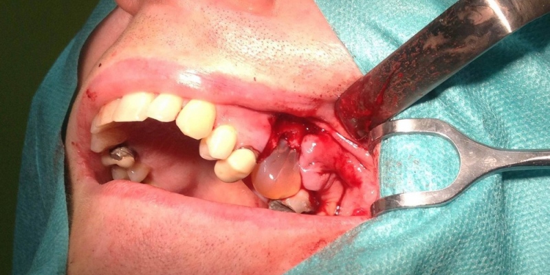 Cystectomia Cystectomia