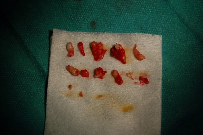 Chirurgia detí a dorastu - zuby Chirurgia detí a dorastu - zuby