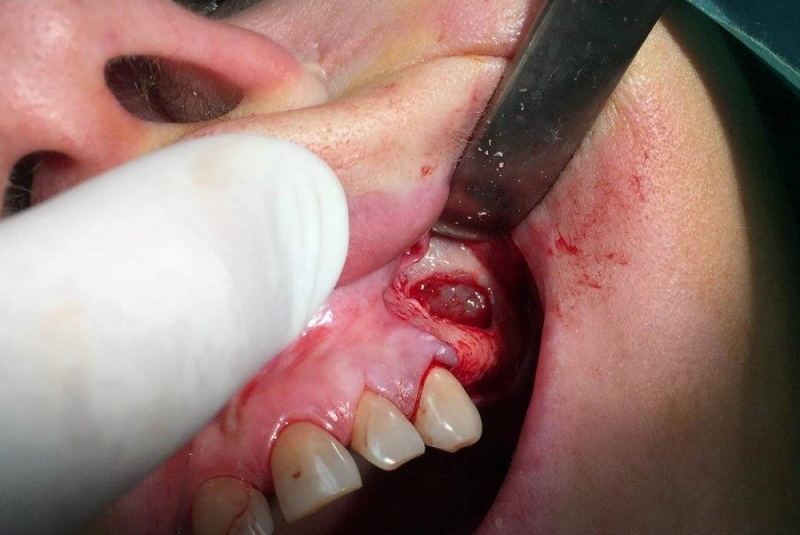 Implantológia Implantológia