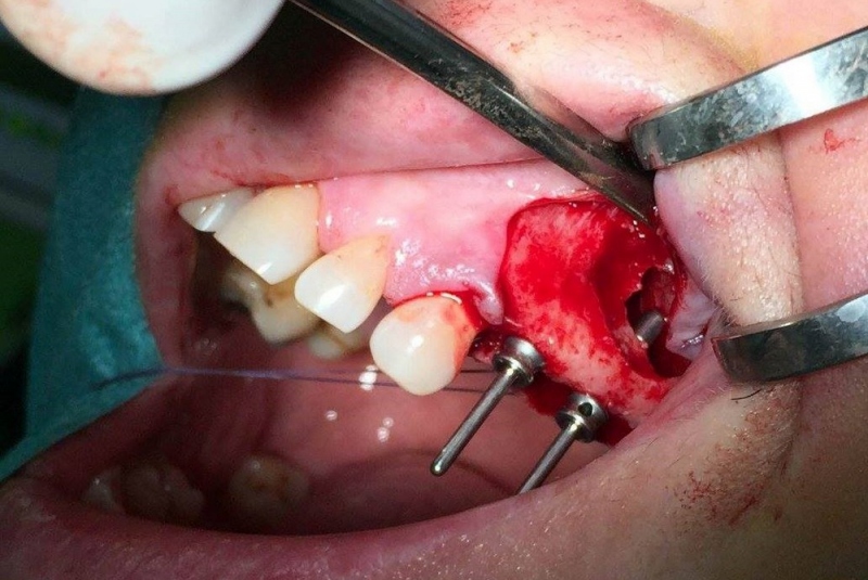 Implantológia