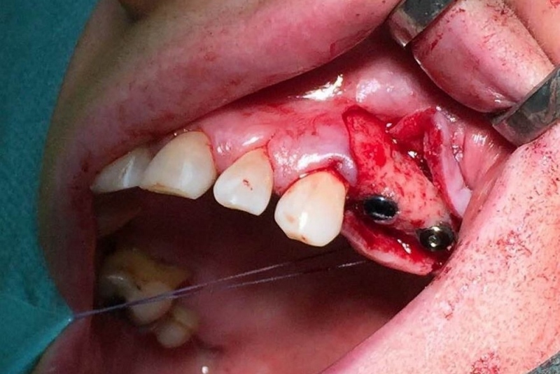 Implantológia Implantológia