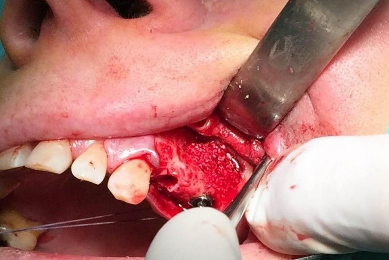 Implantológia Implantológia