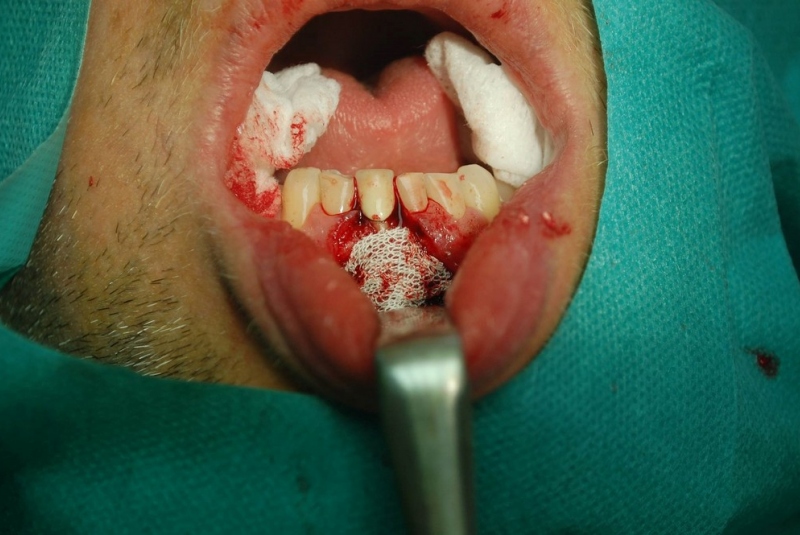 Implantológia Implantológia