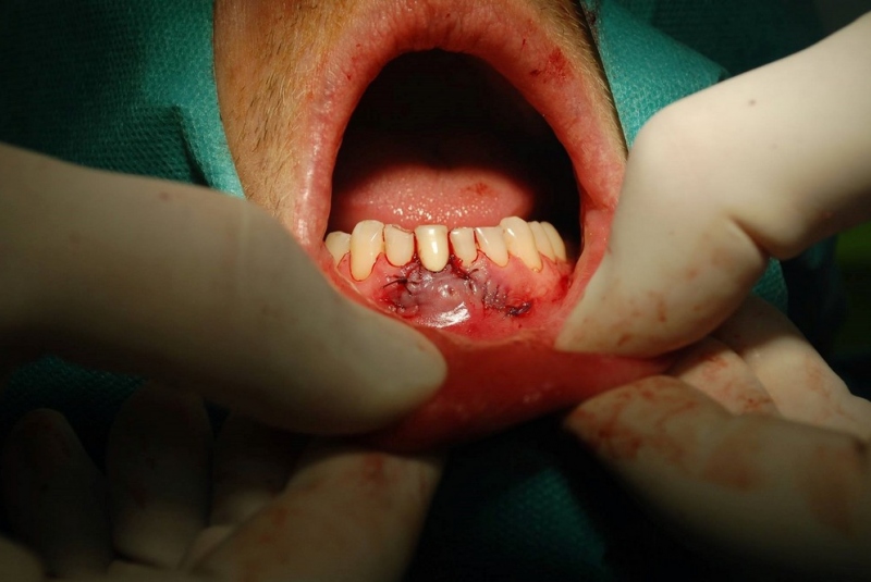 Implantológia Implantológia