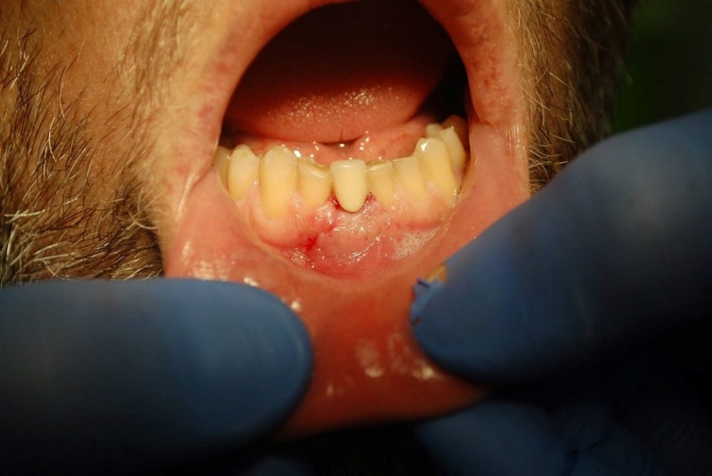 Implantológia Implantológia