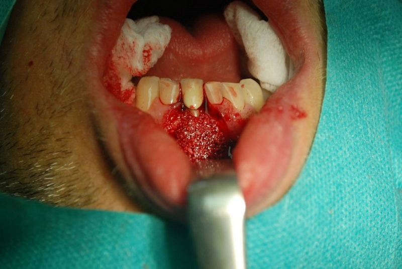 Implantológia Implantológia