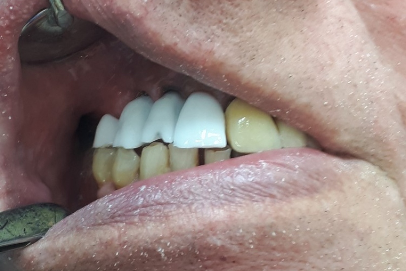 Implantológia, vrátane 3D